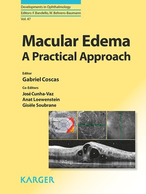 cover image of Macular Edema
